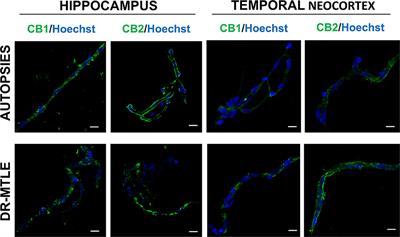 Drug-Resistant Temporal Lobe Epilepsy Alters the Expression and Functional Coupling to Gαi/o Proteins of CB1 and CB2 Receptors in the Microvasculature of the Human Brain